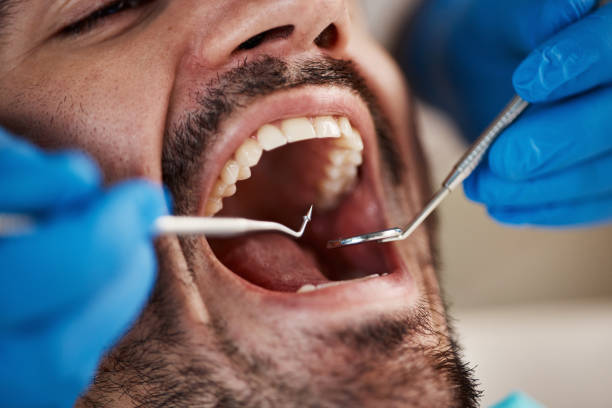 Best Emergency Dentist for Lost Fillings or Crowns in Gerdine, AL